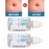 Piercing Bump Removal Drops, Piercing Aftercare Keloid Drops Favorise la Guérison Prévient les Inflammations pour un Usage Qu