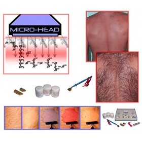 Aavexx Micro 1000 Mikrolyse für Genen Therapie für dauerhafte Haarentfernung