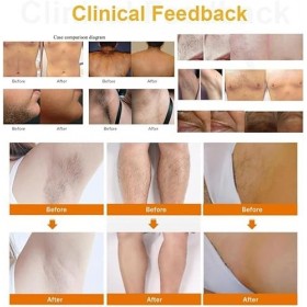 Appareil dépilation, système dépilation laser indolore longue durée pour homme et femme, visage, jambes et bras, zone bikin