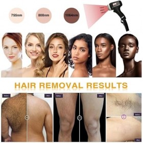 Machine dépilation laser à fil - Appareil dépilation permanente - Épilation à diode indolore - 755 nm - 808 nm - 1064 nm