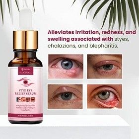 RUIGEQIJI Traitement pour les yeux, retrait du chalazion, retrait du chalazion et du traitement de la blépharite, soulagement