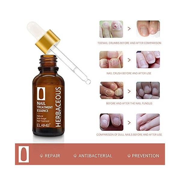 Traitement Des Ongles 30ML Traitement de lOngle Mycosé Soin Mycose Ongles des Pieds Champignons Des Ongles Promotion De La R