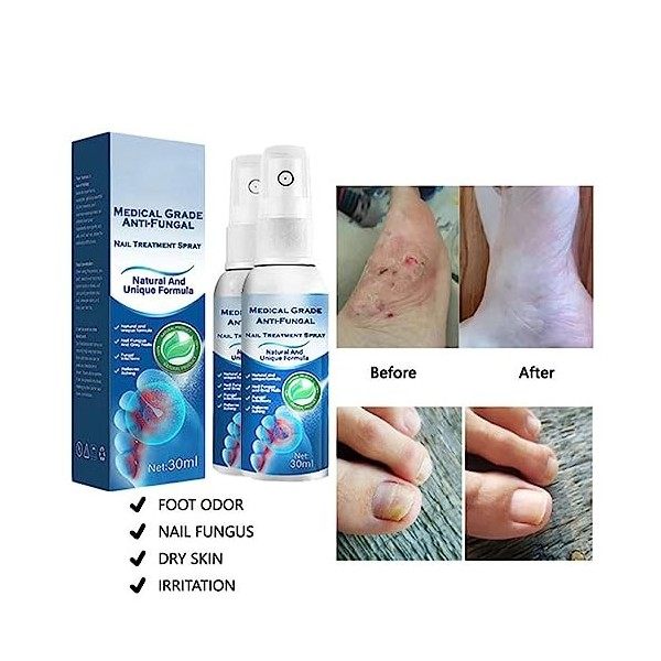 Oveallgo™ Spray de Traitement Antifongique Pour Ongles de Qualité Médicale, Solution de Réparation des Ongles, Liquide de Ren