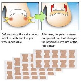 Patch De Bâton Dongle Incarné, Autocollant de correction des ongles, Correction Ongles Incarnés,Correcteur De Paronychie Soi
