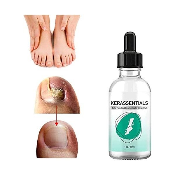 Kerassentials Huile de traitement contre les champignons des ongles dorteils, Kerassentials pour traitement des ongles 1 pi