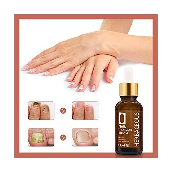 Solution de traitement fongique pour ongles de 30 ml avec coupeongles en acier inoxydable, antichampignons pour ongles des or