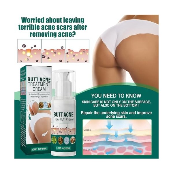 Crème Pour Les Boutons Des Fesses,Crème Délimination des Boutons des Fesses,Crème de Traitement de Lacné des Hanches,Répara