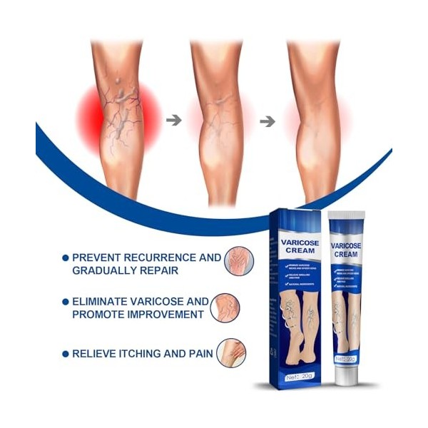 Varicose Veins Cream, 2 Pièces Varices Crème, Varices Jambes Crème, Varices Traitement Jambes Crème, Crème pour les Varices, 