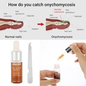 Essence de réparation ongles,protection pour le clou endommagé, ongle dAnti Fongique dorteil de doigt,ongles Soins liquide