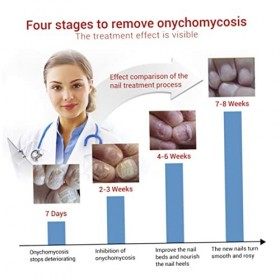 Traitement fongique des ongles 1PC Traitement des ongles Solution de renouvellement des ongles Ongles et ongles Répare les on