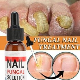 Traitement Fongique des Ongles, Renouvellement de la Mycose des Ongles, Solution de Soin des Ongles et des Ongles, Solution d