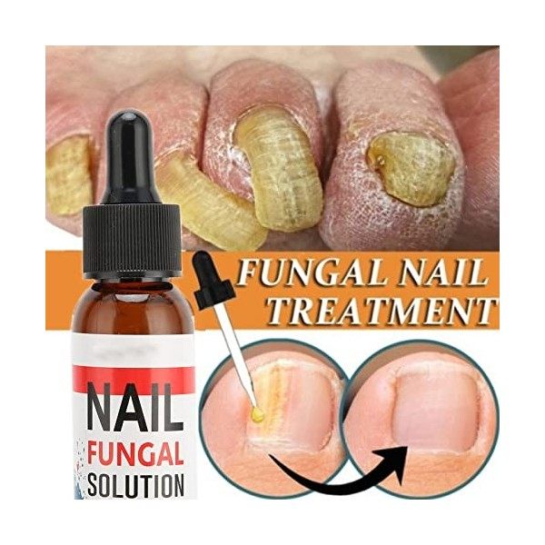 Traitement Fongique des Ongles, Renouvellement de la Mycose des Ongles, Solution de Soin des Ongles et des Ongles, Solution d