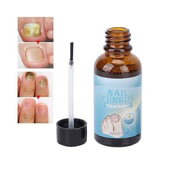 Traitement des maladies fongiques des ongles, absorption délicate, sûre et rapide, capacité 30 ml, pour le traitement des