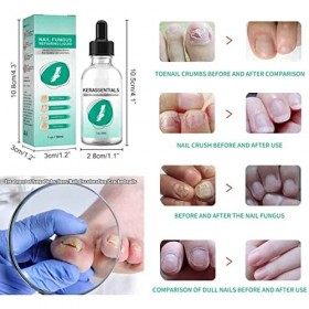 2Pcs Kerassentials Huile de Traitement des Champignons des Ongles des Pieds,Anti Fongique Mycoses Nails Traitement Antifongiq