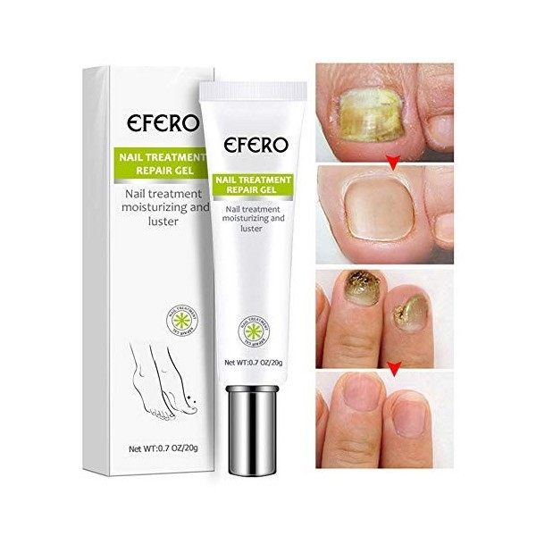 Gel de réparation de traitement des ongles enlever lonychomycose ongles cassés crème de réparation des ongles antifongiques 