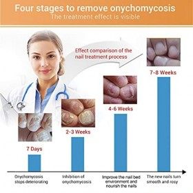 15 ml naturel puissant, essence de réparation des ongles anti-fongique, solution de réparation efficace pour le traitement de