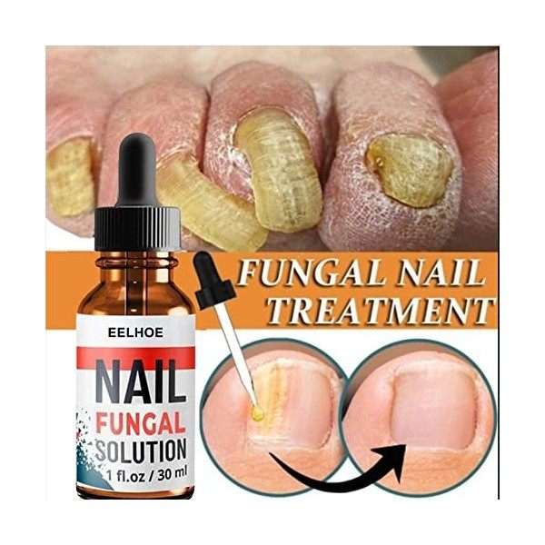 OEDO Kit de réparation des ongles Trousse Fungal Nails et Toenails Solution pour réparer et renouveler les ongles fongiques e