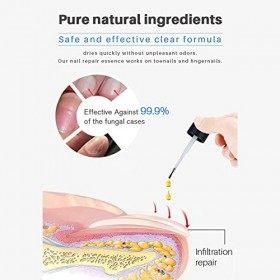 Ensemble de traitement des champignons des ongles des orteils, solution de traitement des ongles fongiques Prévention des inf