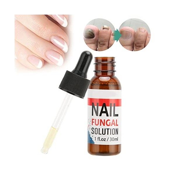 Renouvellement fongique des ongles Traitement des champignons des ongles Solution de soins de santé pour le pied dathlète