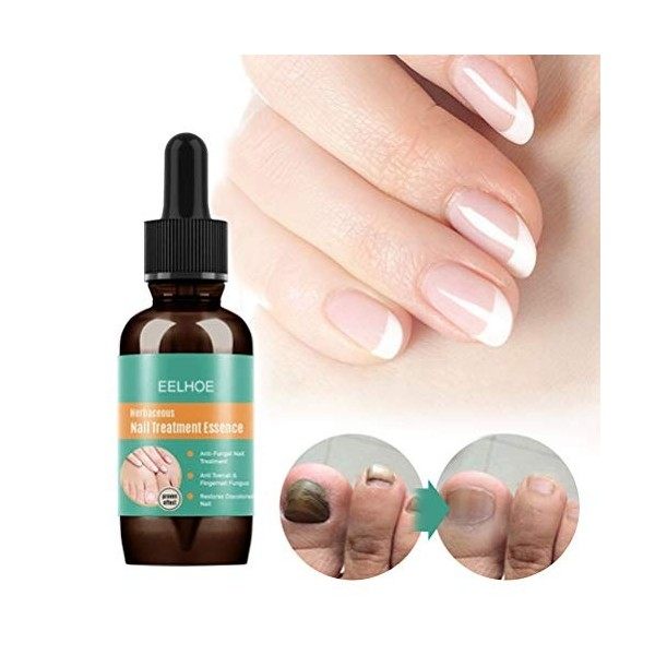 MSLing Kit de traitement anti-fongique pour les ongles des doigts et des orteils - 30 ml