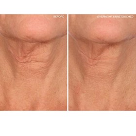 SiO | Patch anti-rides au niveau de lencolure | Patchs en silicone lissant la nuit pour les rides, les ridules et le cou de 