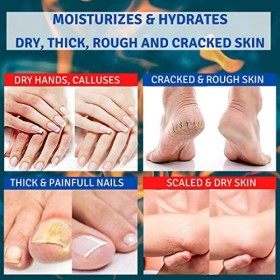 Crème durée 30% TIS - Élimine les cicatrices, leczéma, la kératose, le psoriasis, les éruptions cutanées Pour les peaux sèc