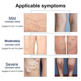 VaricesSpray Varices,Varices Crème, Varices Traitement, Varices et jambes fatiguées