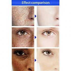 Symeas Crème éclaircissante pour la peau, crème de traitement Melasma, crème anti-taches de rousseur pour éclaircir le visage