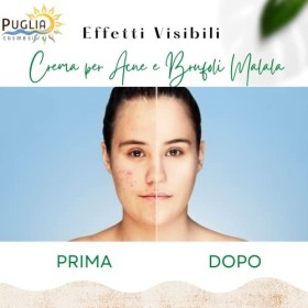 Puglia Cosmesi Bio Malala Acne Pimples Face Cream, pour les peaux grasses et acnéiques, avec acide mandélique, ortie et thym,
