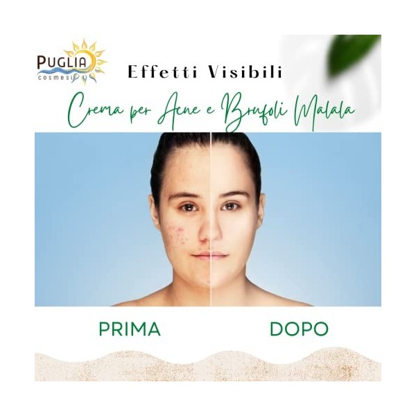 Puglia Cosmesi Bio Malala Acne Pimples Face Cream, pour les peaux grasses et acnéiques, avec acide mandélique, ortie et thym,