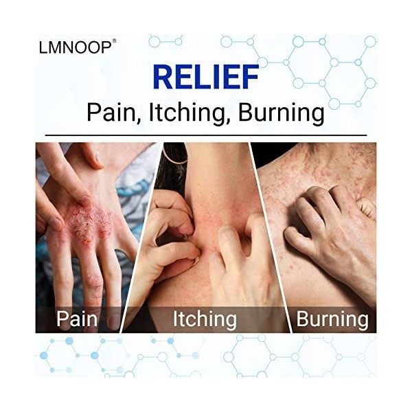 LMNOOP Eczema Cream, Pommade de traitement de force maximale pour le psoriasis,la dermatite,la teigne des pieds,les infection