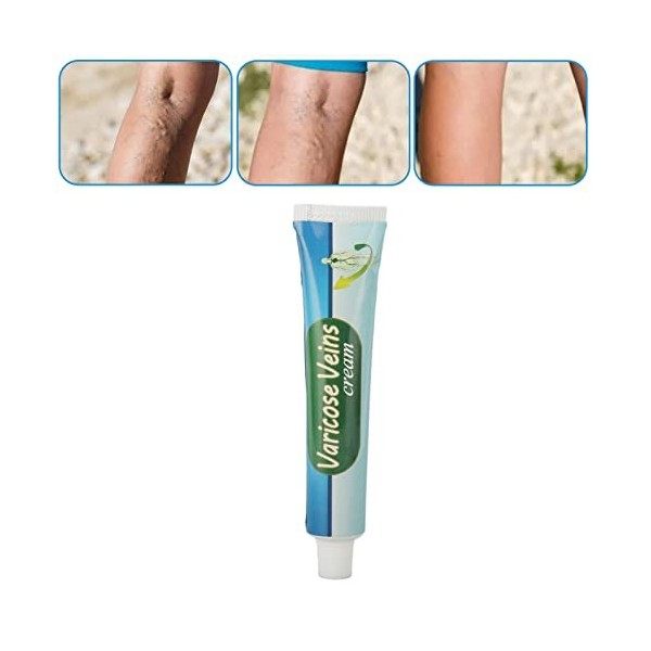 Crème de traitement des varices, crème pour varices Perméation rapide Nutrition naturelle Utilisation externe modérée pour la