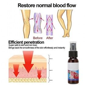 Spray de Traitement des Varices Professionnel pour le Soulagement de la Douleur des Jambes, le Sérum Apaisant pour les Varico