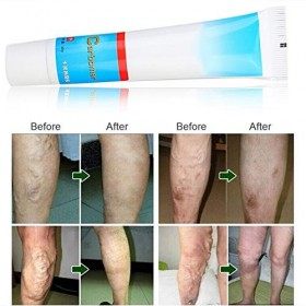 Crème Vasculaire Varices, Crème de Massage Homme et Femme Jambes Anti-Lourdes et Fatiguées, Crème Apaisante Jambes pour Enlev