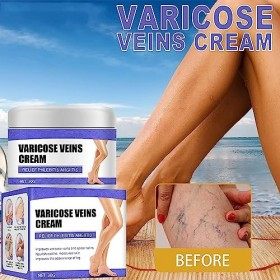 Tkekruh Crème Contre Les Varicosités,Varicose Vein Repair Cream,Réparation Des Jambes DAraignée,Traitement Des Varices Pour 