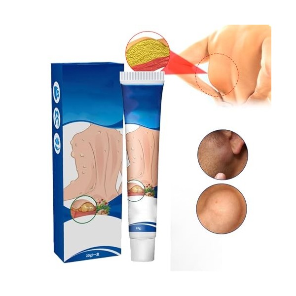Lipoma Removal Cream,Crème Délimination Des Lipomes,Pommade Apaisante pour Les Lipomes,Pommade de Suppression sûre à Utilise