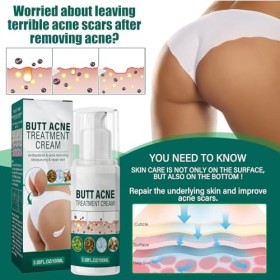 KOAHDE Crème pour les Boutons des Fesses,Crème Délimination des Boutons des Fesses,Crème Nettoyante Anti-Friction,Crème Anti