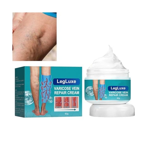 Crème pour Varices,Crème Soin Des Jambes,Réparation Des Jambes DAraignée,Crème Contre Les Varicosités,Creme Anti Varices Crè