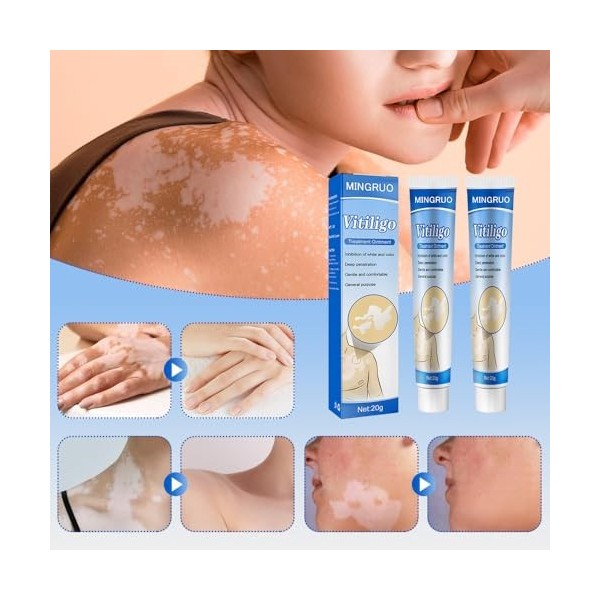MINGRUO 2Pcs Vitiligo Cream, Vitiligo Pommade, Crème De Soin Des Points De Fleurs, Crème pour la Peau Vitiligo, Crème De Soin