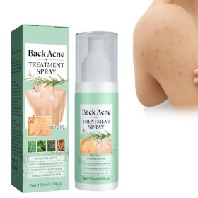 Spray Contre lacné du Dos, Spray de Traitement de lacné pour le Dos et lacné, Spray pour le dos et le Corps, Éclaircir les
