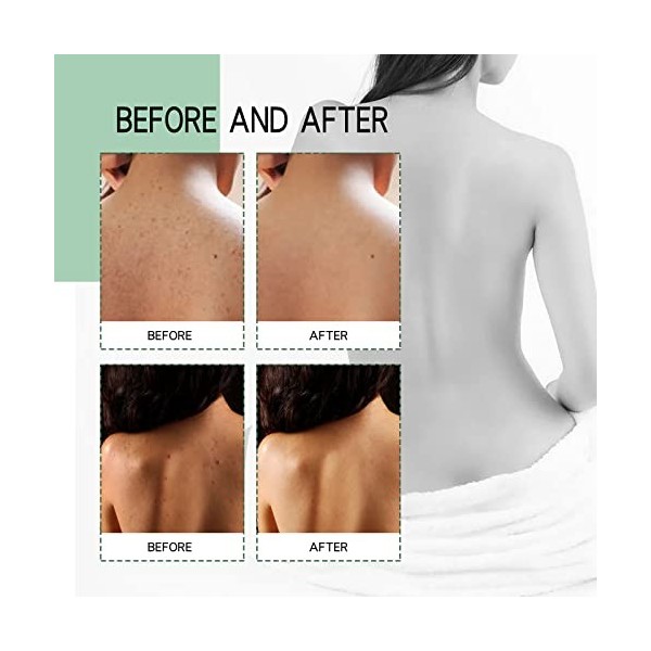 Spray Contre lacné du Dos, Spray de Traitement de lacné pour le Dos et lacné, Spray pour le dos et le Corps, Éclaircir les