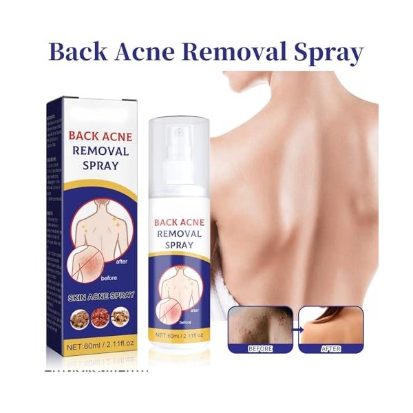 Pemarlis 2pcs*60ml Spray de traitement de lacné du dos, Exfoliant pour le dos,nettoyage en profondeur,Éclaircir les marques 