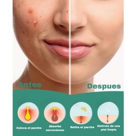 MAGLEM Lot de 144 patchs à lhuile darbre à thé et à lacide salicylique pour éliminer lacné rapidement