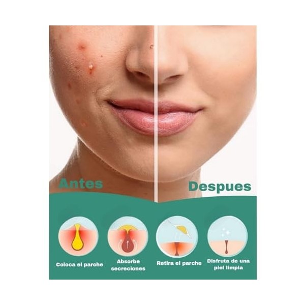 MAGLEM Lot de 144 patchs à lhuile darbre à thé et à lacide salicylique pour éliminer lacné rapidement