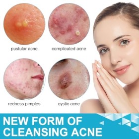 Shefave Pimple Patches Micro Needle, Pansements hydrocolloïdes, patchs microneedling pour lacné Se débarrasser rapidement de