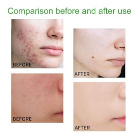 Nettoyant Anti-Bouton À Lacide Salicylique, Mousse Nettoyante Pour Le Visage, Pour Nettoyer les Pores en Profondeur et Hydra