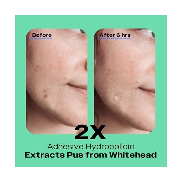 AVARELLE Patch pour boutons dacné 40 unités Traitement hydrocolloïde absorbant avec huile darbre à thé, huile de calendul