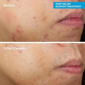 Murad Traitement des imperfections en profondeur - Contrôle des imperfections - Force maximale 2% dacide salicylique - Trait