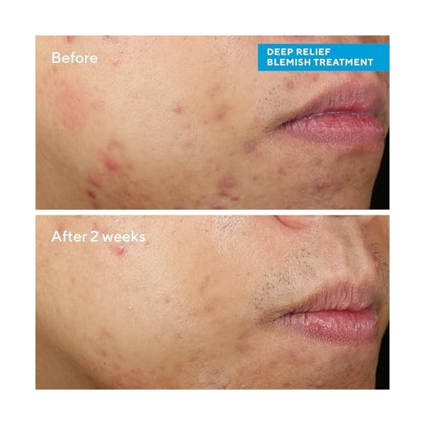 Murad Traitement des imperfections en profondeur - Contrôle des imperfections - Force maximale 2% dacide salicylique - Trait