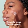 Micropoint™ for Blemishes from Hero Cosmetics - Hydrocolloid Acne Spot Treatment Patch for Early Stage Zits and Hidden Pimple
